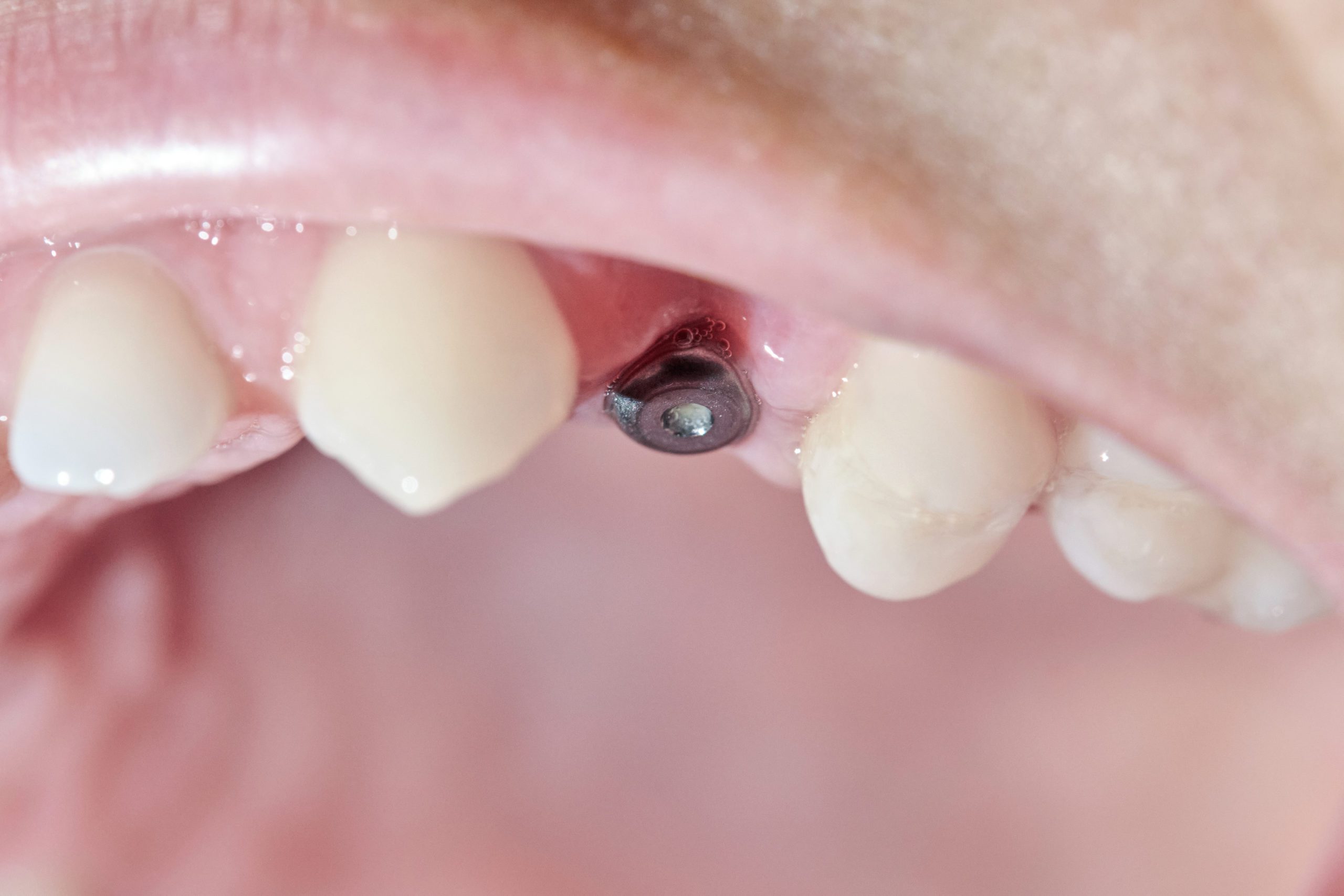 Dental Implants in San Diego, California | First Impressions Dental